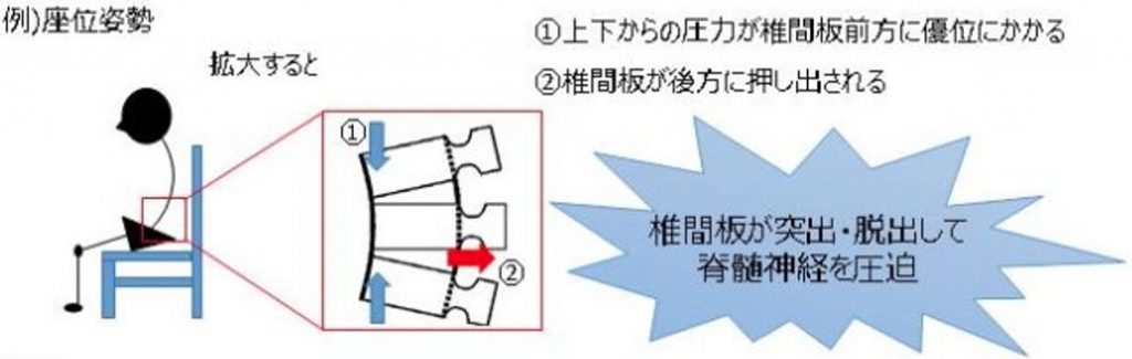 腰痛・神経圧迫・姿勢