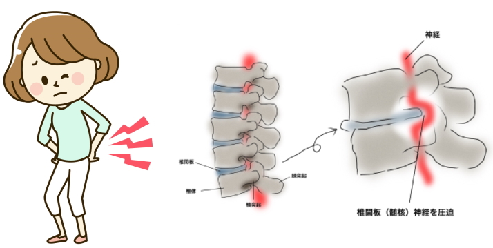 腰椎椎間板ヘルニア