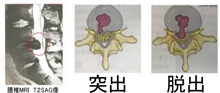 腰椎椎間板ヘルニアMRI