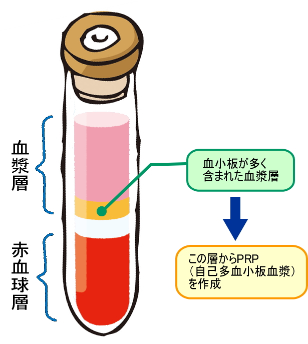 PRP療法採血