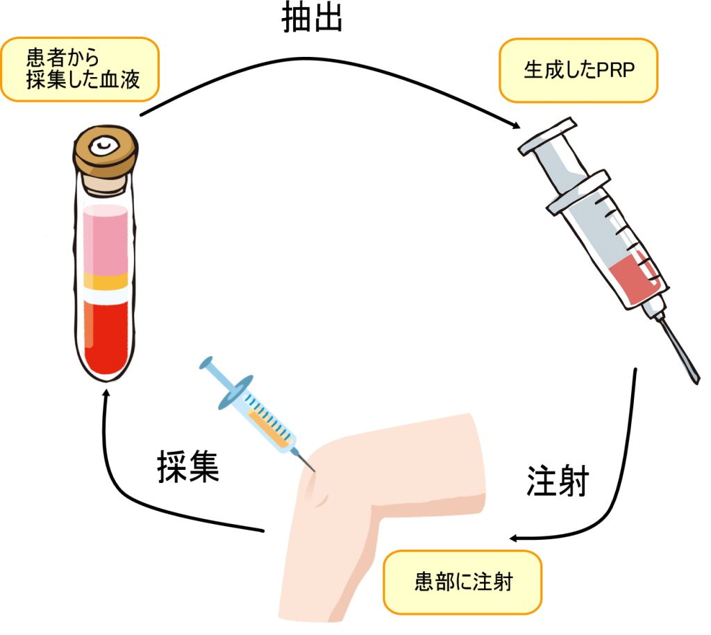 PRP療法ながれ