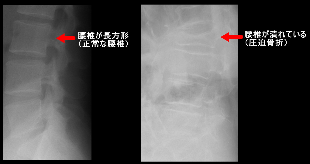 圧迫骨折レントゲン