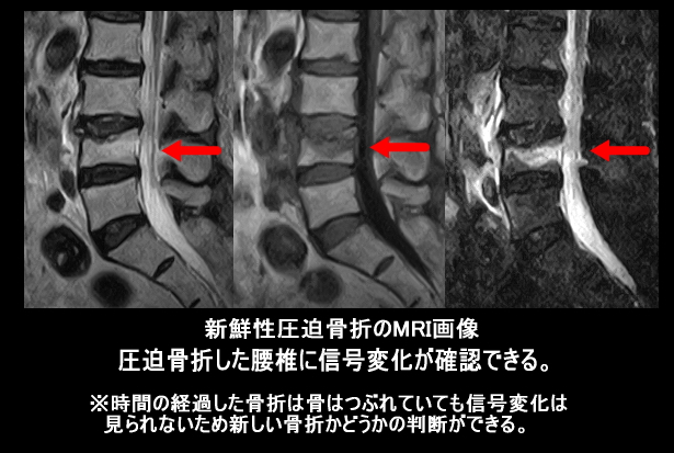 圧迫骨折MRI